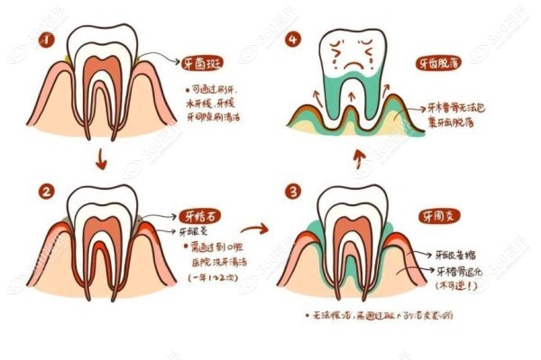 牙齿掉的只剩根了怎么处理？