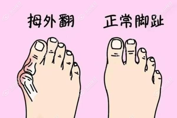 苏敬达做大脚骨手术技术水平咋样.jpg
