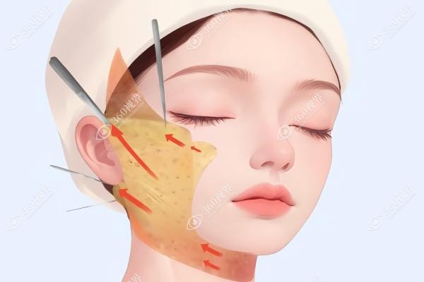 做过拉皮手术后悔要死-害怕有后遗症/没效果的来看我做拉皮手术真实感受