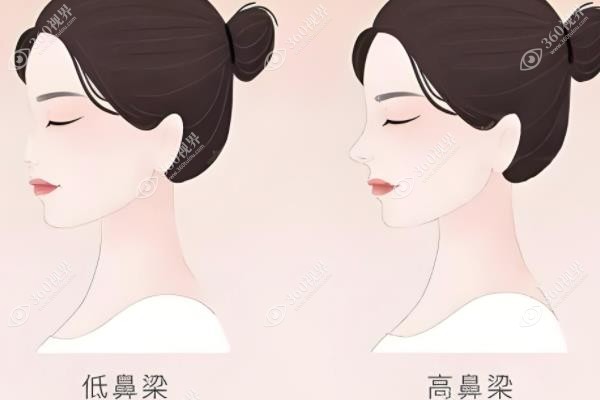 北京奥尔贝德整形医院做鼻子好吗?姚然做鼻子自然立体术后真实且价格透明.jpg