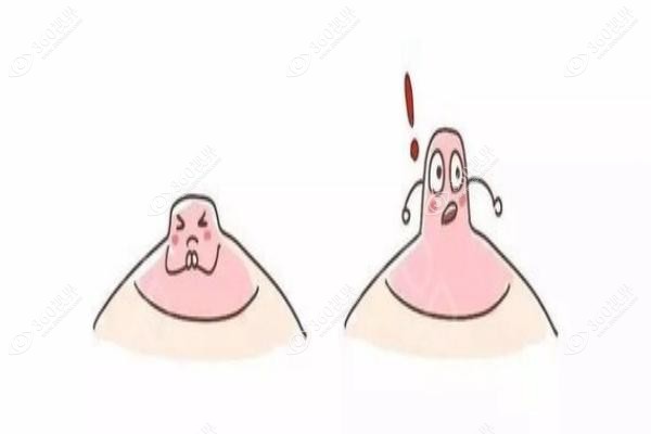 乳晕缩小手术以后还能哺乳吗?通常不影响哺乳且不会因哺乳变大反弹,价格在5k-1w左右