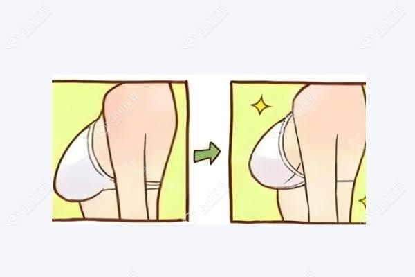 巨乳缩小手术怎么做.jpg