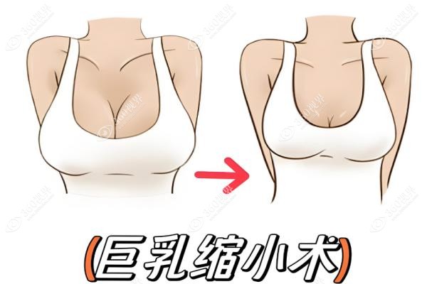 巨乳缩小手术要多少钱？费用1-8万区间揭秘！手术方式+年龄限制全解析