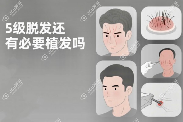 5级脱发还有必要植发吗？