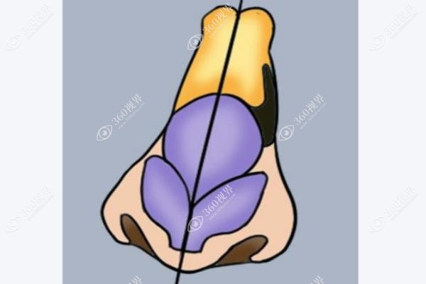 歪鼻矫正费用一般多少钱.jpg