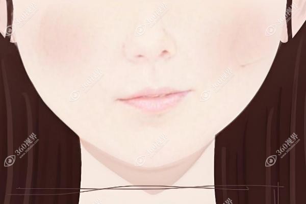歪鼻矫正手术亲身经历-含我的歪鼻矫正医生选择/恢复期/费用分享
