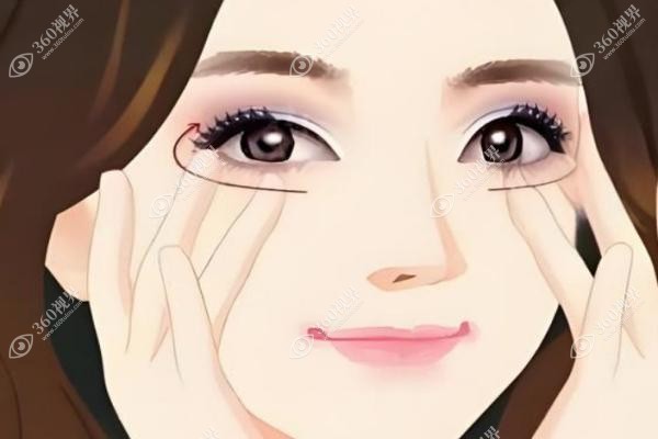 杜园园眼睛修复案 例