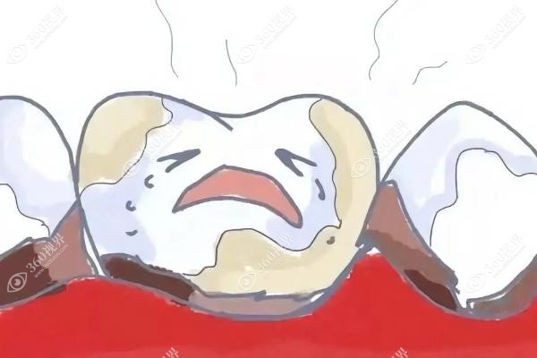 牙齿脱矿怎么办？从造成原因到补救方法/修复价格一并分享!