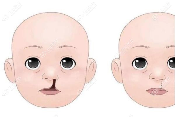 上海唇裂修复技术排名靠前的医院