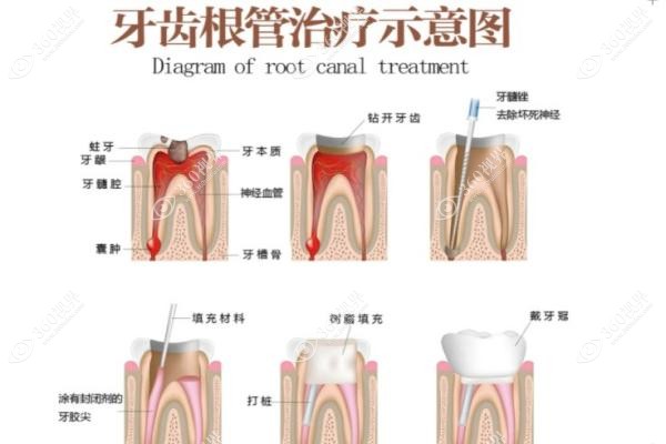 杭州富阳区根管治疗价格表查询：前牙300起/后牙880起医 保报销比例实测