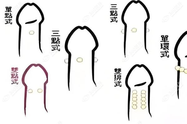 入珠手术正规医院可以做.jpg