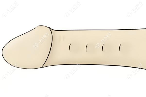 入珠手术多少钱.jpg