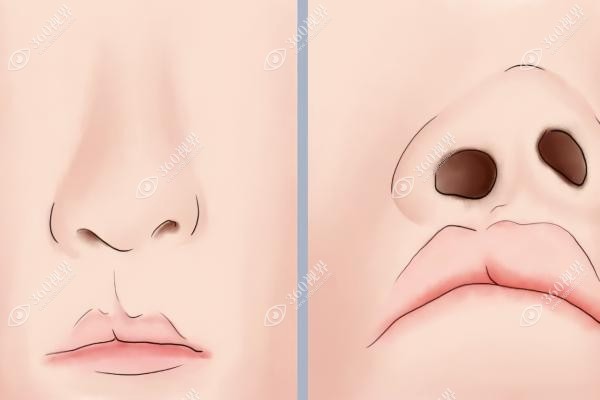 唇裂导致鼻孔不一样大怎么办？鼻孔一个大一个小能恢复,详看矫正方案及价格