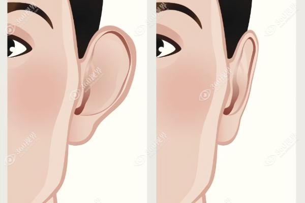 先天性耳朵畸形手术多少钱.jpg