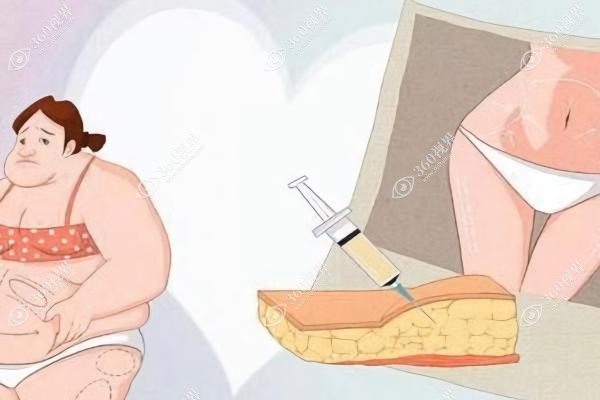 腰腹环吸术后真实感受.jpg