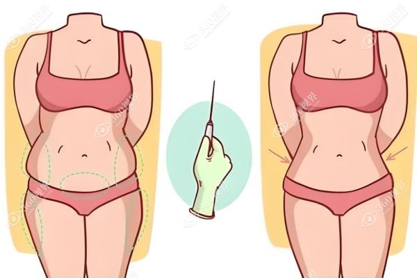 广州军美王世虎做吸脂怎么样?纯手工柔性吸脂技术好且吸脂无失败<span style=