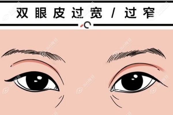 双眼皮埋线好还是割好到底哪好?区别在:创伤小推荐埋线/结果稳推荐全割