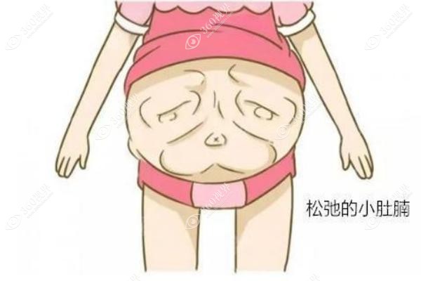 剖腹产四次还能做腹壁成形手术吗？宝妈真实案例：从松弛肚到紧致腰线的效果对比
