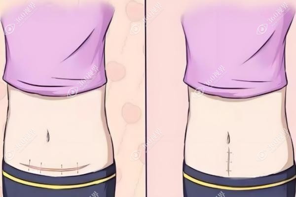 剖腹产四次还能做腹壁修补术吗？.jpg