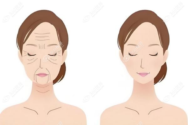 川字纹怎么弄才能去掉?通过手术去除也可填充胶原蛋白/玻尿酸消除