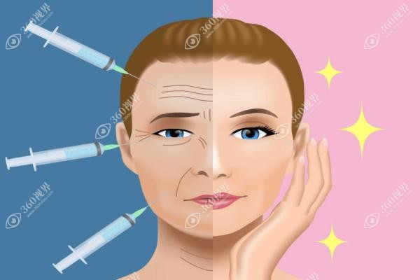 川字纹怎么弄才能去掉?通过手术去除也可填充胶原蛋白/玻尿酸消除.jpg