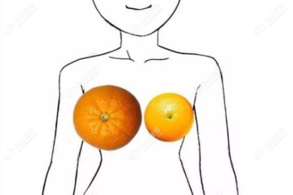 假体隆胸术后真实感受:亲测1年软如真胸效果自然/带娃哺乳毫无问题