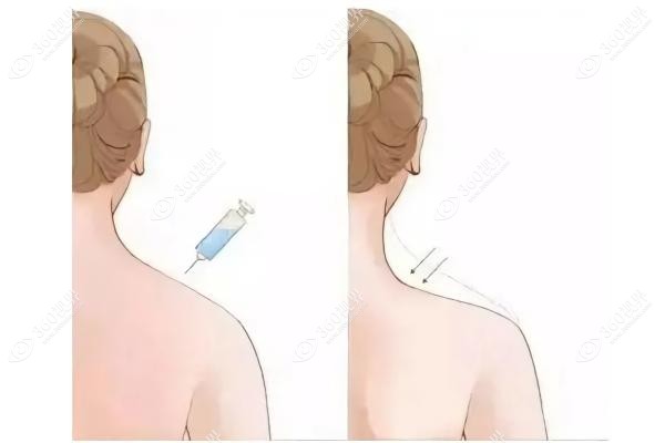 颈阔肌成形术效 果保持几年.jpg 颈阔肌成形术效 果保持几年.jpg