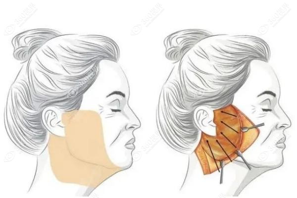 袁强博士和谢宏彬谁厉害？30岁选微创袁强，50岁冲谢宏彬深层抗衰