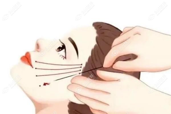 袁强拉皮属于什么档次