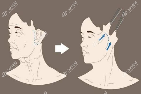 朱乐林磨骨三件套多少钱？7万含颧骨内推，朱乐林磨骨资历排前三可闭眼冲