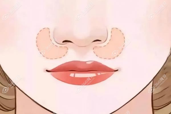 悦龄塑填充鼻基底能保持多久？一般可以保持6~12个月有效果且不会移位呢