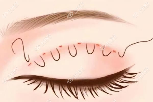 吕方中医生口碑如何？实测吕方中修复双眼皮技术好口碑棒!附个人简历