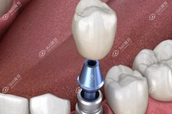 奥齿泰种植牙使用寿命 奥齿泰种植牙使用寿命