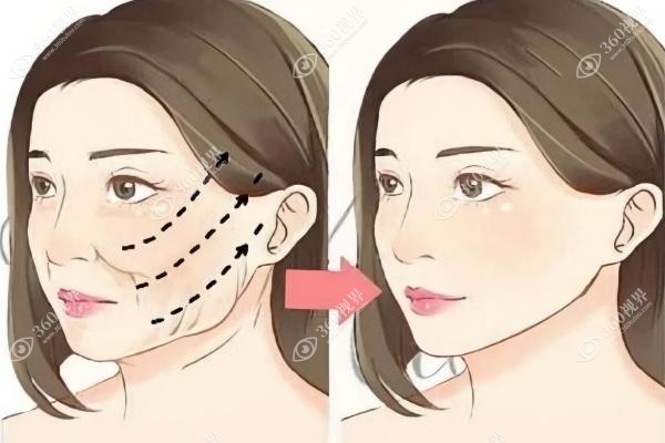 黄广香在哪家医院怎样预约？一键电话预约广州中家医做拉皮手术!