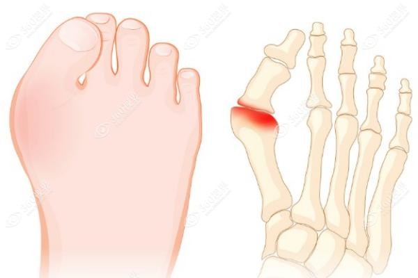 拇外翻手术哪家医院好全国排行：微创技术前三强医院深度对比