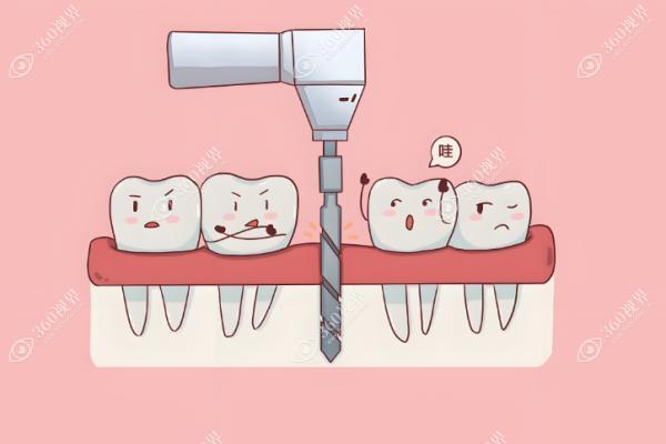 穿颧穿翼种植牙1