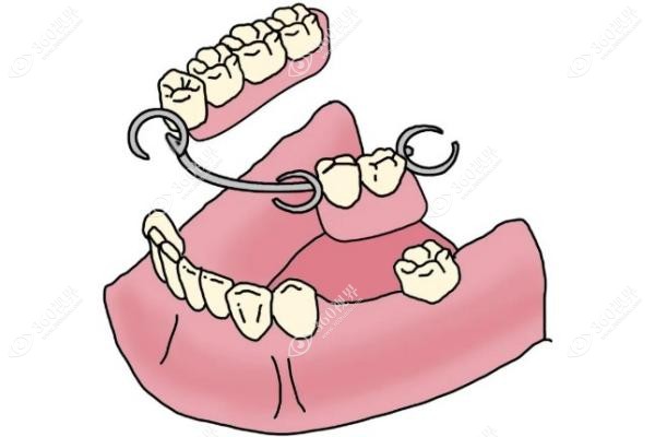 活动假牙品牌排行榜：凯晶塑钢牙+拜耳牙国产双雄，卫健委认证防坑指南
