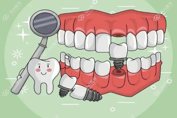 活动假牙什么材质好 活动假牙什么材质好