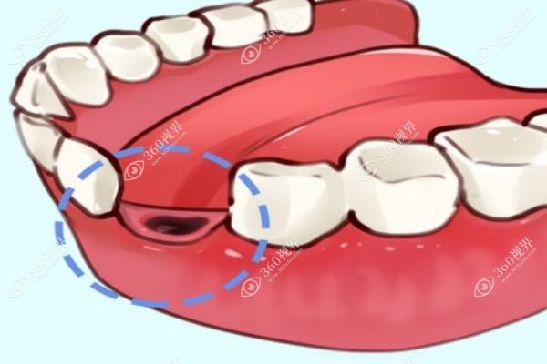 活动假牙的种类及价格表 活动假牙的种类及价格表
