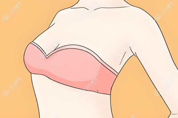 穆大力缩胸手术做得好吗？参考穆大力缩胸手术案例就知好在哪里!