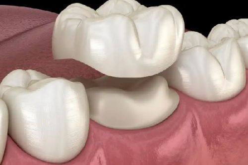 登腾种植体型号和规格大揭秘-常用登腾种植体型号全知晓，还告诉你一颗登腾种植体多少钱！ 