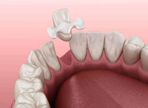 三、登腾种植体多少钱一颗?