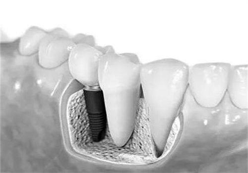 长春爱馨口腔种植牙怎么样？技术优医生强服务好-种牙价格低至880元起！