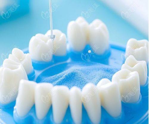 全口种植牙齿需要多少钱？价格在3万——21万左右附国内全口种植技术靠谱的口腔