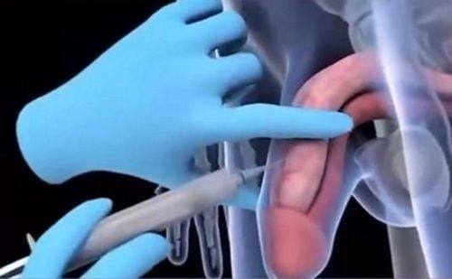 玻尿酸阴茎增大加粗靠谱吗？靠谱!含玻尿酸增大丁丁效果及价格详解