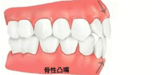 做一套假牙大概多少钱？活动假牙500元/固定假牙800k+/全口假牙4k+ 