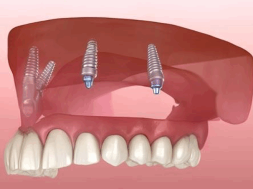 佛山牙科收费价目表：牙齿矫正4k+/种植牙5k+/补牙95元+