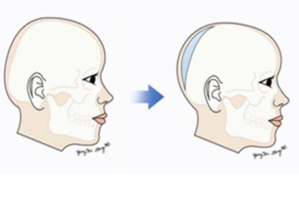 头顶填充整形谁做过?有患者分享:头顶填充改善头型效果明显/术后头型圆润饱满超自然 