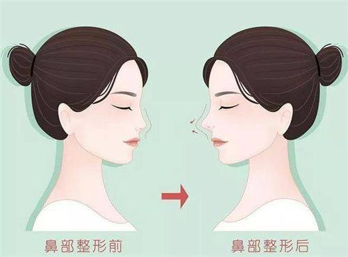 深圳文丰医生做肋骨鼻多少钱？初鼻整形2.8W+/鼻修复3.8W+/鼻综合套餐6.8W+