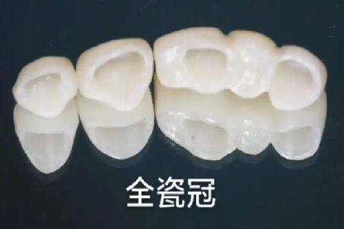 全瓷牙色号怎么选择？应结合自身牙色与美观需求，正规医院医生评估建议更靠谱 